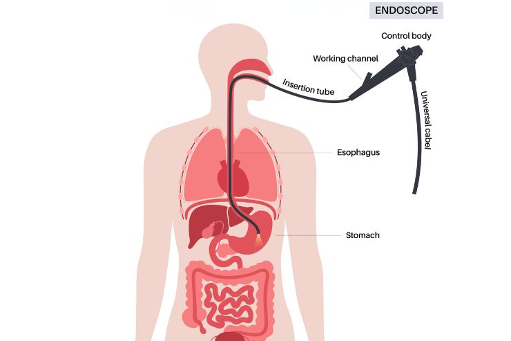 Endoscopy