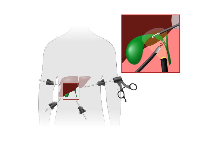 Lap Cholecystectomy