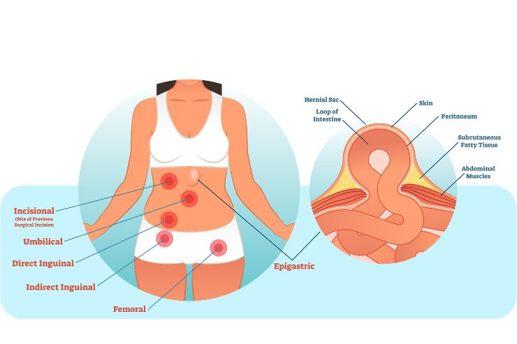 Lap Hernia repair