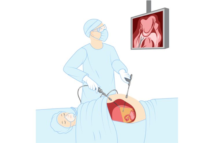 Laparoscopic surgery