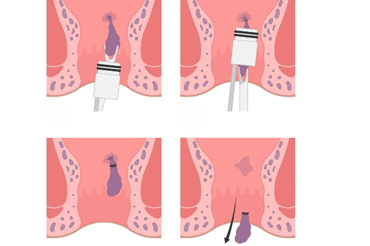 Laser Hemorroidectomy