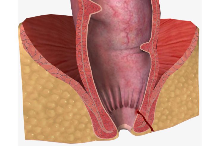 Laser fistulectomy