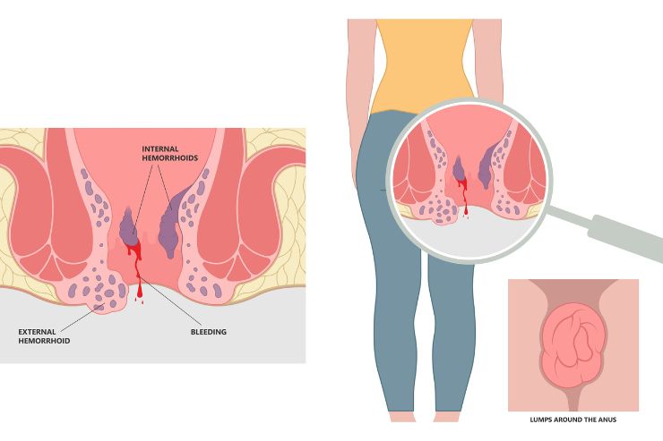 Rectal bleed clinic