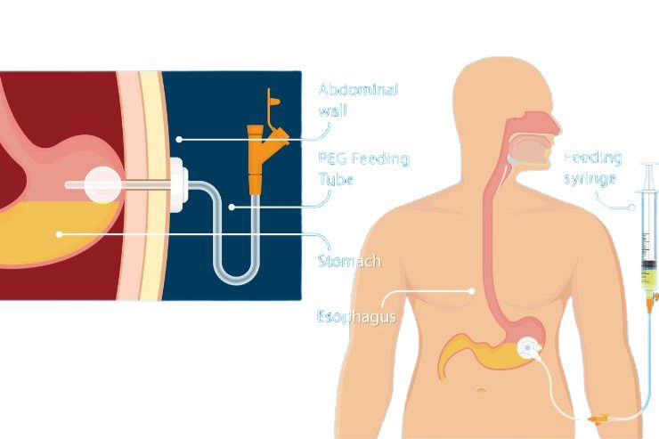 PEG Tube Placement