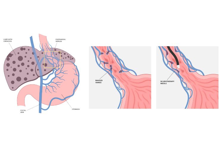 Variceal Band Ligation