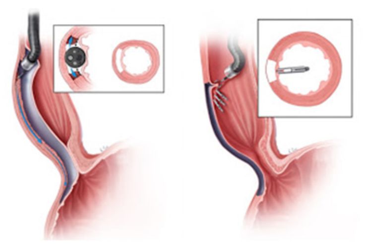 Third Space Endoscopy